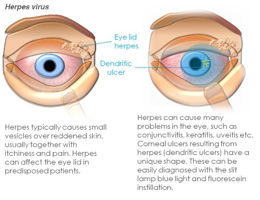 image-708659-s40herpes.jpg